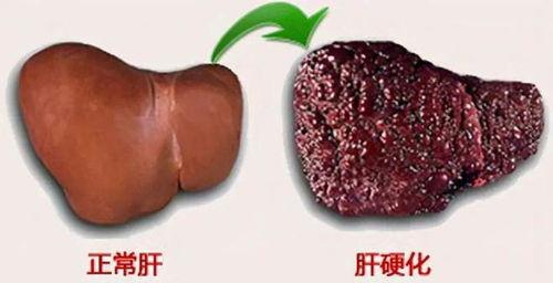 肝硬化可以吃嫩瓜